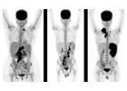 Accurate PET Scan in Mumbai for Cancer Detection – Picture This 