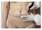 Affordable Cost of Liposuction in Cape Town for Body Contouring