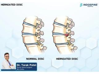 Herniated Disc Treatment for Back and Leg Pain | Advanced Spine Care