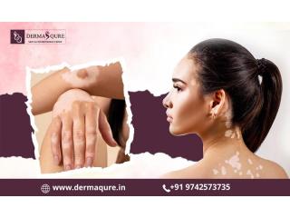 Personalized Advanced Vitiligo Treatment in Bangalore - Dermaqure