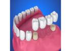 Best Tooth Crown & Dental Bridges Treatment in Thoothukudi