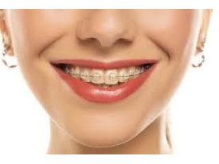 Removable Teeth Braces Dombivli for Perfect Smile