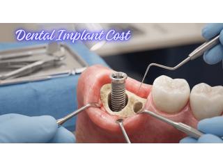 What Really Decides Dental Implant Cost in Mumbai?