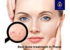 Get the Best Acne Treatment in Thane with DNA Royal Experts.