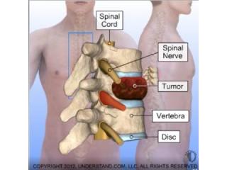 Advanced Scoliosis Surgery & Spine Treatment in Ahmedabad