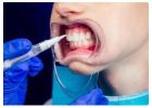 Advanced Gum Grafting in Beverly Hills for Healthier Smiles
