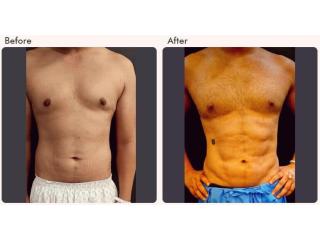 Six Pack Abs Surgery in Delhi - Dr Rajat Gupta