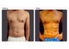 Six Pack Abs Surgery in Delhi - Dr Rajat Gupta