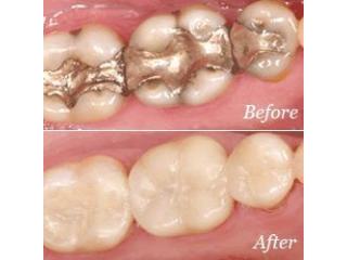 Professional Dental Crowns in Laguna Hills with Modern Care