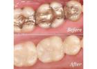 Professional Dental Crowns in Laguna Hills with Modern Care