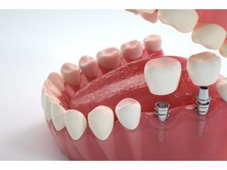 Cheap Implant in Northeast Philadelphia