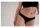 Affordable Liposuction Cost in South Africa for Body Contouring Solutions