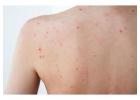Body Acne Treatment in Delhi at Iksana wellness