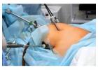 Laparoscopic Hernia Surgery in Kolkata  