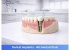 Dental Implants in Mumbai | Safe & Long-Lasting | AK Dental Clinic