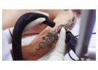 Best Way to Remove Tattoo in Mckinney | Premier Tattoo