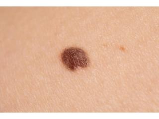 Mole Removal in Milton Keynes – Book Your Consultation