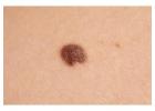 Mole Removal in Milton Keynes  –  Book Your Consultation