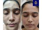 Professional Anti Ageing Skin Care Services in Thane | DNA Royal.