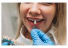 Porcelain Veneers in Allen, TX