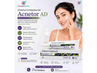 Acnetor AD Gel | Adapalene & Clindamycin Acne Medication for Acne Vulgaris