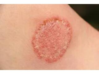 Skin Fungal Infection Treatment for Healthy & Clear Skin