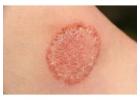 Skin Fungal Infection Treatment for Healthy & Clear Skin