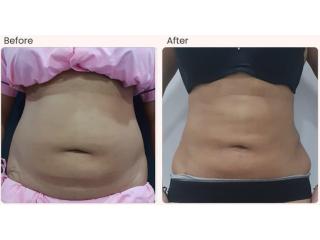 Liposuction Surgery Cost in Delhi - Dr Rajat Gupta