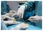 Trusted Relief from Fistula with Expert Surgical Care