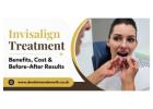 Invisalign Treatment Benefits, Cost and Before-After Results