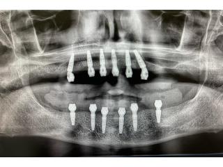 Dental implants Tijuana offers natural-looking and durable teeth replacements