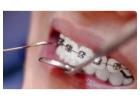 Professional Dental Cleaning Near You – Call Now