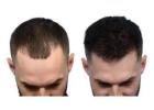 Hair Transplant in India | Advanced & Affordable Treatment with Mycure Pathway