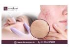 Transform Your Skin with Professional Acne Treatment in Bangalore