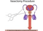Convenient Vasectomy Services Near You in Cape Town
