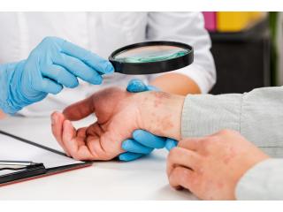 Psoriasis Treatment in Delhi – Advanced Care at Iksana Wellness
