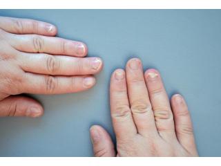 Nail Disorder Treatment in Delhi – Expert Care at Iksana Wellness