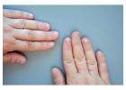 Nail Disorder Treatment in Delhi – Expert Care at Iksana Wellness