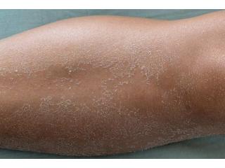 Dry Skin Treatment in Delhi – Advanced Care at Iksana Wellness
