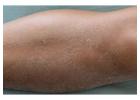 Dry Skin Treatment in Delhi – Advanced Care at Iksana Wellness