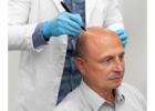 Men’s Hair Replacement London – Natural Hair Systems