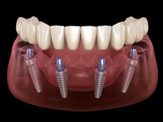 All-on-4 Dental Implants in Tijuana, Mexico – Affordable, Life-Changing Results!