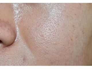 How to Control Oily Skin