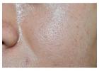 How to Control Oily Skin