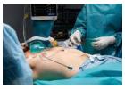 Advanced Laparoscopic Gallbladder Surgery in Kolkata