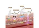 HIFU Treatment in Chandigarh for Youthful Skin Tightening