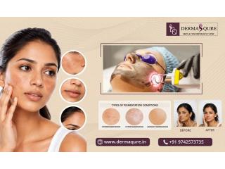 Reveal Radiant Skin with Laser Pigmentation Treatment in Bangalore - Dermaqure