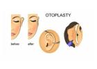 Ear Reshaping Surgery in Delhi - Dr Rajat Gupta