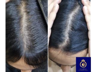 DNA Royal Offers the Best Hair Regrowth for Women in Thane.