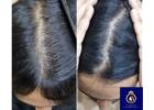 DNA Royal Offers the Best Hair Regrowth for Women in Thane.